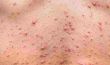 BIG NEWS: MP में चिकनपॉक्स के 31 मामले, नीमच-भोपाल सहित ये जिले शामिल, अब एडवाइजरी जारी, स्वास्थ्य आयुक्त ने दिए ये निर्देश...! पढ़े खबर