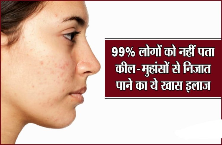 HEALTH TIPS : क्या आप भी एक्ने और मुहासे से है परेशान, तो अपनाये यह 5 नुस्के, जल्द मिलेगा इनसे छुटकारा, आइये जानते है कोनसे है वे 5 फॉर्मूले, पढ़े इस खबर में